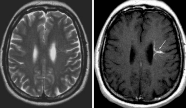 МР-снимки головного мозга