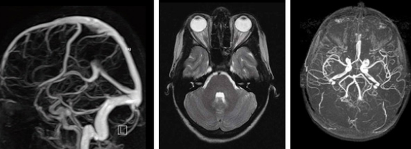 Снимки МРТ сосудов и головного мозга 