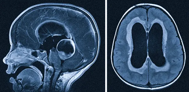 Гидроцефалия на снимках МРТ