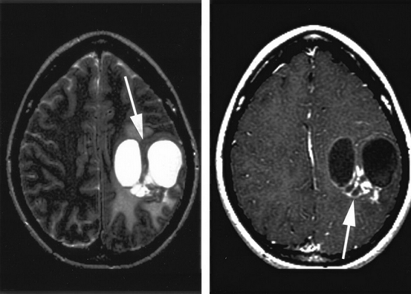 Киста головного мозга при разных режимах МР-сканирования