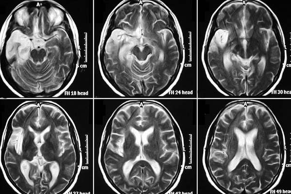 Признаки энцефалопатии на снимках МРТ