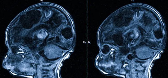 Гидроцефалия новорожденного на томографических изображениях