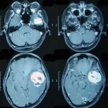 Как делают МРТ головного мозга