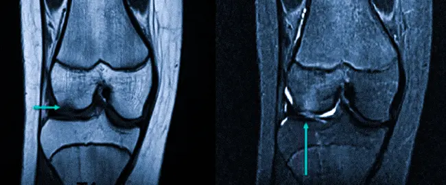Субхондральный перелом латерального мыщелка на МРТ