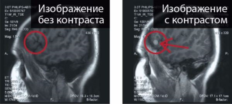 МРТ головы с контрастом и без контраста