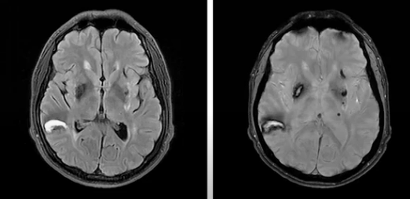 Кровоизлияния в головной мозг на МРТ