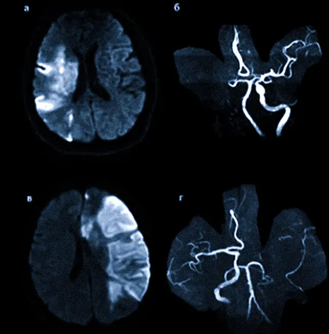 Нарушение мозгового кровообращения на МРТ