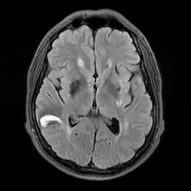 Как проходит МРТ сосудов головного мозга?