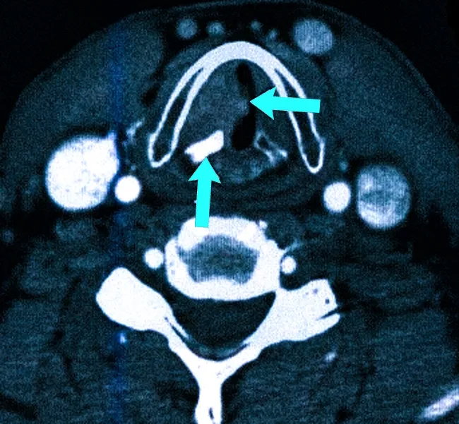 Как выглядит рак горла на КТ