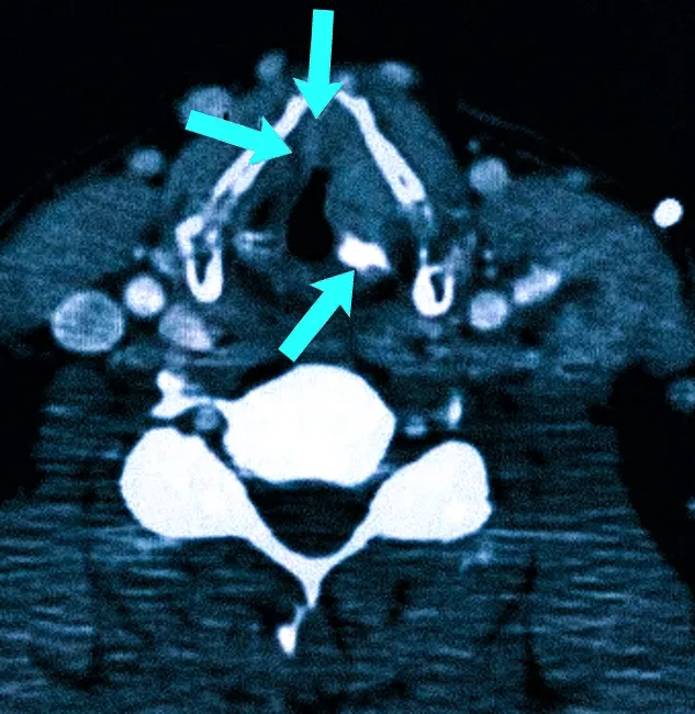 Как выглядит рак горла на КТ