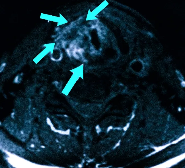 Как выглядит рак горла на КТ