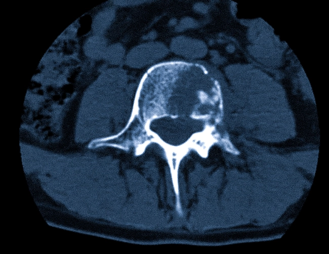 Как выглядят метастазы в позвоночнике на КТ