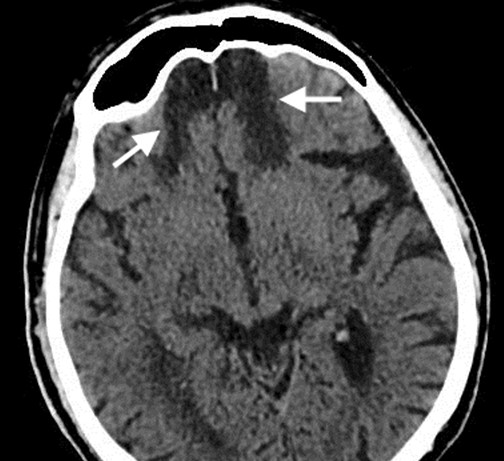  Стрелки указывают на ложные кисты на КТ-снимке головного мозга