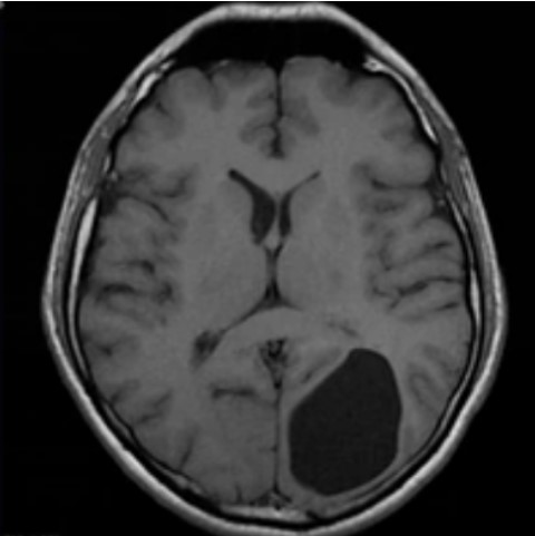 Кистозная структура метастазов в головной мозг на МРТ