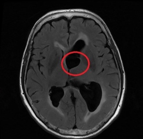 Киста на МРТ головного мозга
