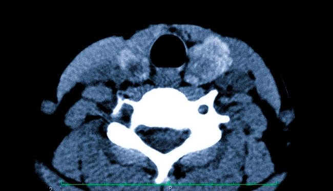 Киста щитовидной железы на КТ