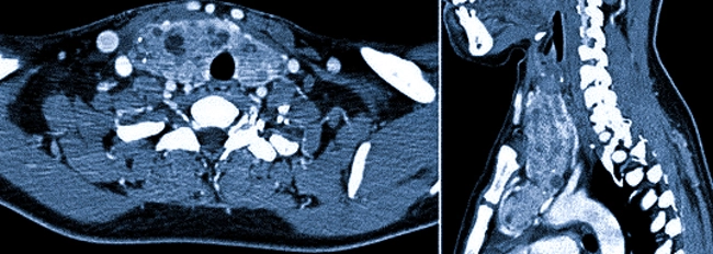 Киста щитовидной железы на КТ