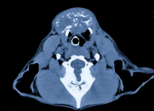 Киста щитовидной железы на КТ