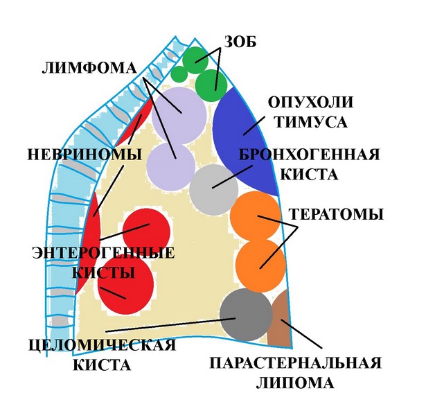 Схематическое изображение расположения кист в полости средостения 