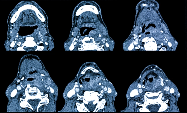 Карцинома глотки на КТ