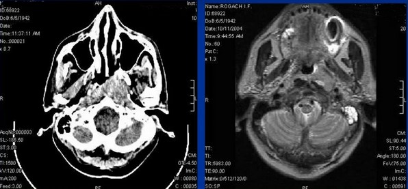 Опухоль носоглотки и средний отит на снимках КТ (слева) и МРТ (справа)