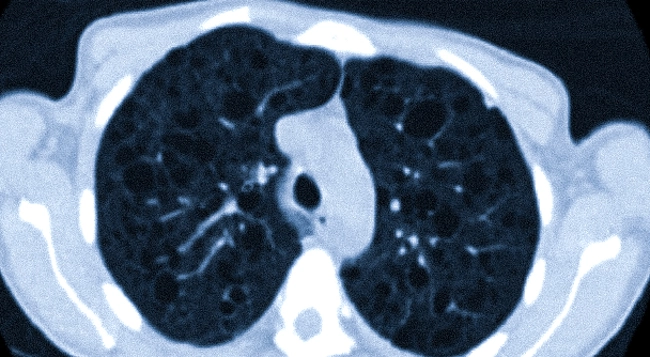 Множественные тонкостенные кисты по всем полям легких