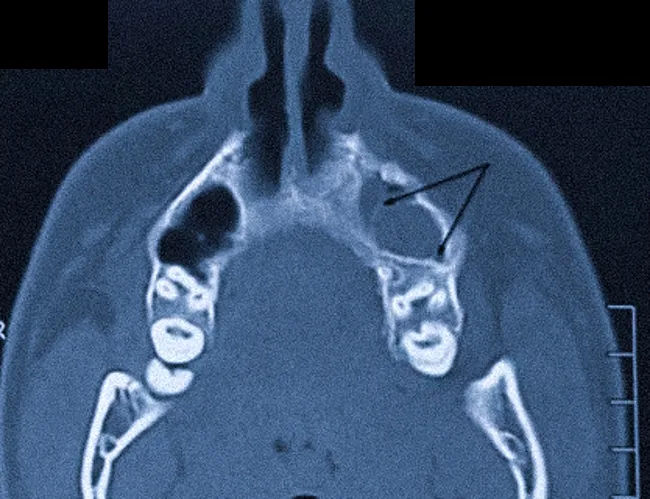 Киста верхней челюсти на КТ
