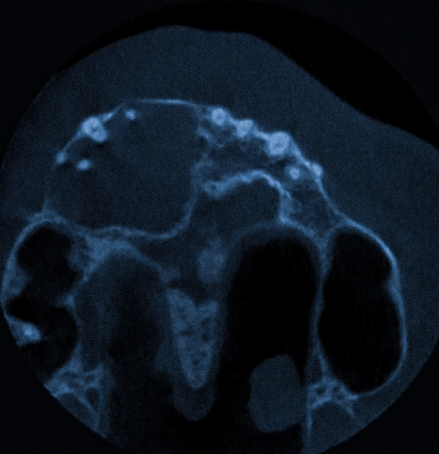 Киста верхней челюсти на КТ
