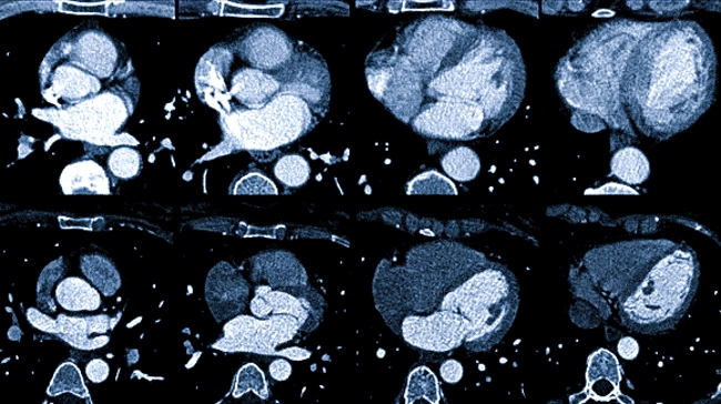 Клапаны сердца на КТ