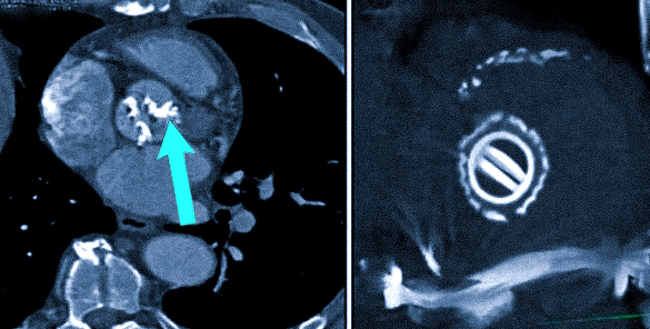 Клапаны сердца на КТ