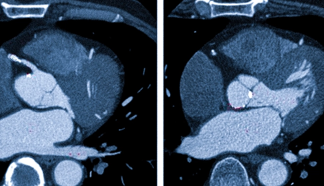 Клапаны сердца на КТ