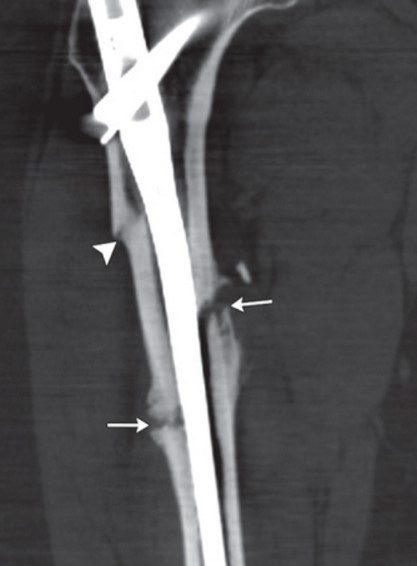Сегментарный перелом шейки бедренной кости на КТ