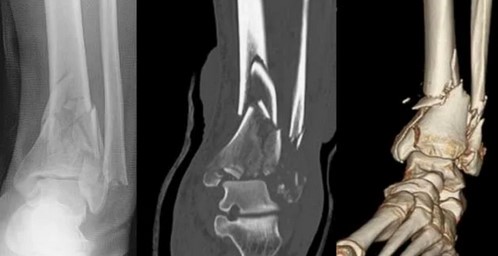 Изображения, полученные с использованием (слева направо): рентгенографии, КТ и мультипланарной реконструкции
