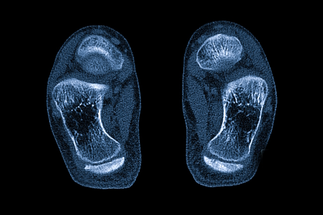 МСКТ пяточной кости