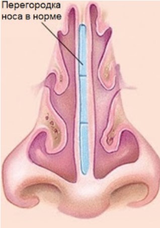 Костный шип носовой перегородки на КТ