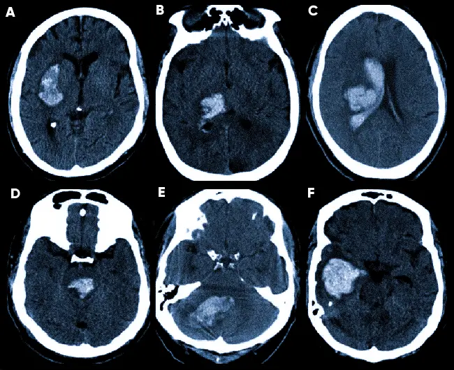 Кровоизлияние в мозг на КТ