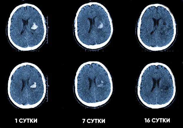 Кровоизлияние в мозг на КТ