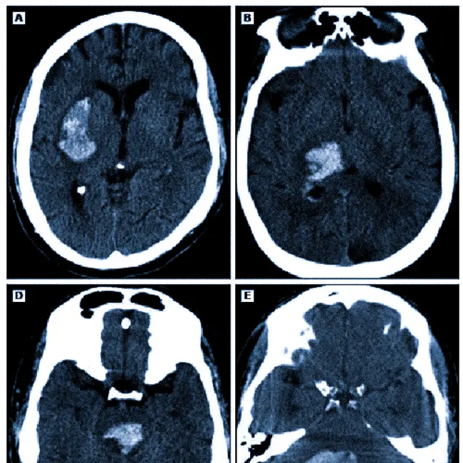 Кровоизлияние в мозг на КТ