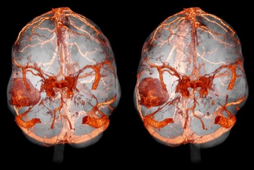 КТ-ангиография кровеносной сети головного мозга