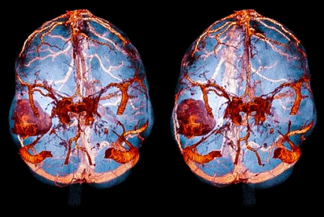 КТ-ангиография кровеносной сети головного мозга