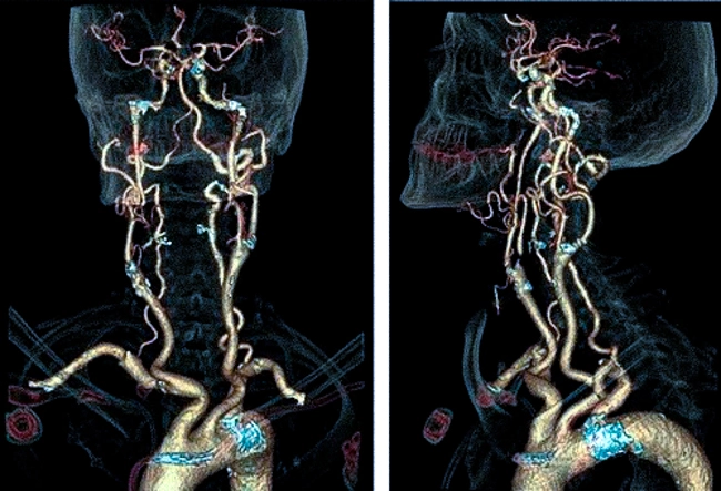 КТА брахиоцефальных артерий