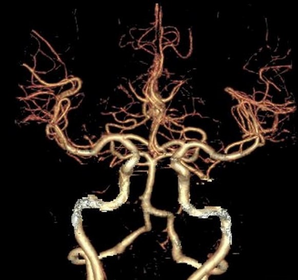 КТ ангиография интракраниальных артерий