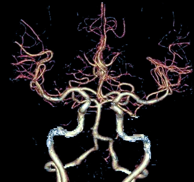 КТ ангиография интракраниальных артерий
