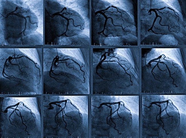 КТ ангиография коронарных артерий
