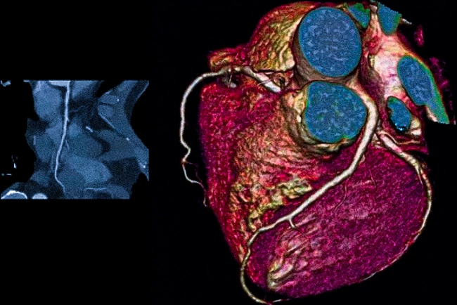 КТ ангиография коронарных артерий
