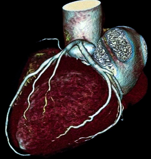 КТ ангиография коронарных артерий