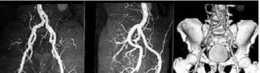Мультиспиральная компьютерная томография подвздошных артерий