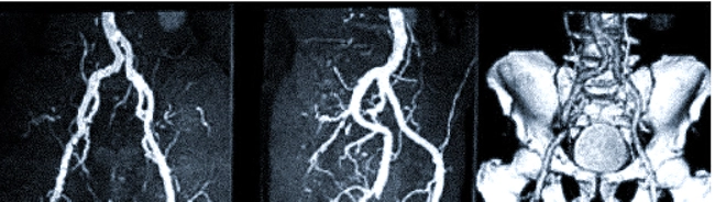 Мультиспиральная компьютерная томография подвздошных артерий