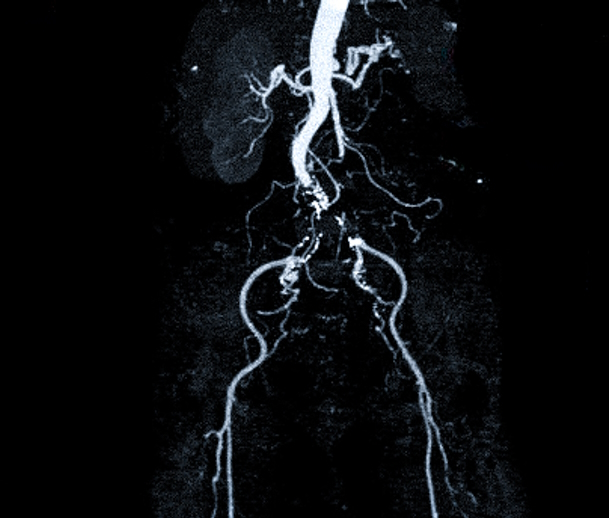 КТ-ангиография подвздошной артерии при синдроме Лериша