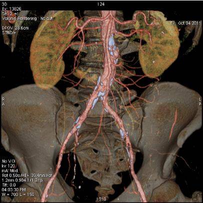 Синдром Лериша: 3D-реконструкция КТ-ангиографии брюшной аорты и  подвздошных артерий